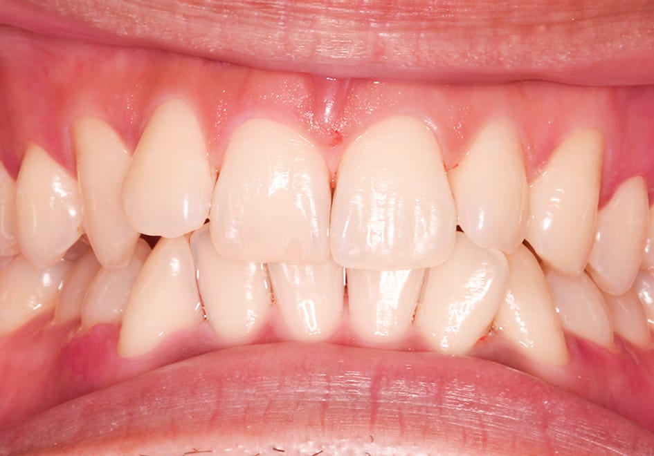 歯のクリーニング治療例