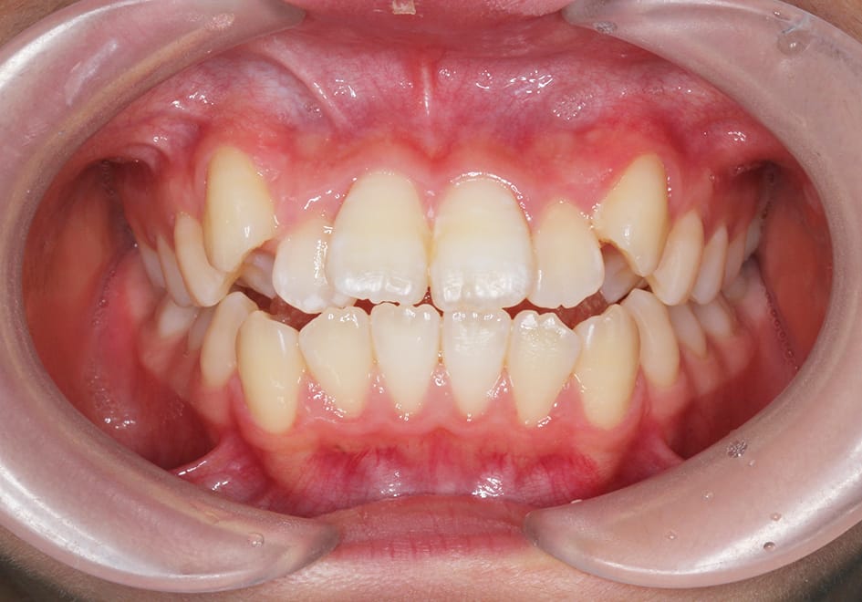 上下顎前歯部叢生の症例の治療例