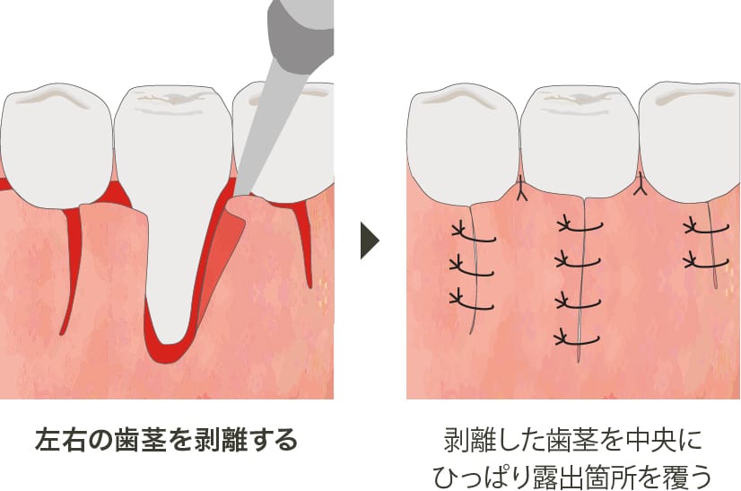 歯肉弁側方移動術