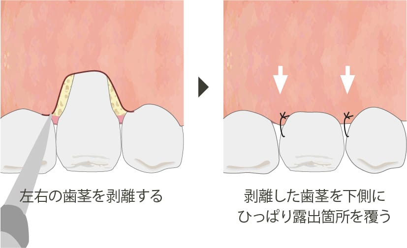 歯肉弁歯冠側移動術