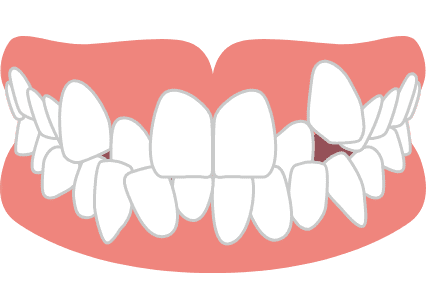 デコボコの歯