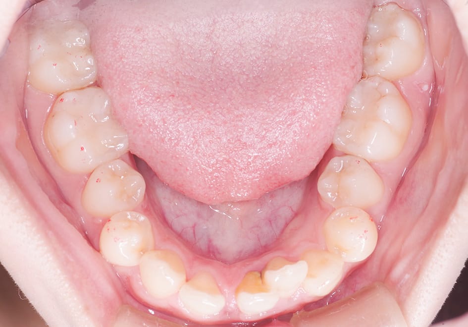 下顎前歯叢生の症例