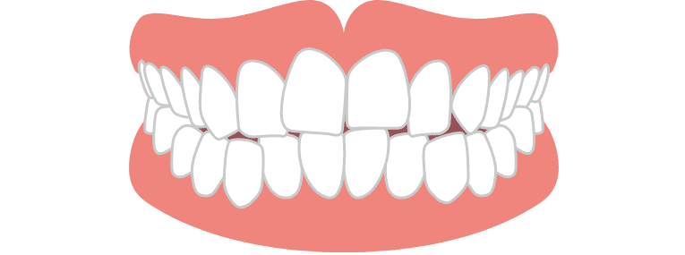 軽度症例（矯正期間：4～5か月）前歯6本矯正 ライト
