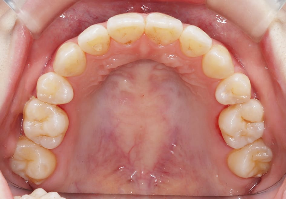 上顎前歯叢生の症例の治療例