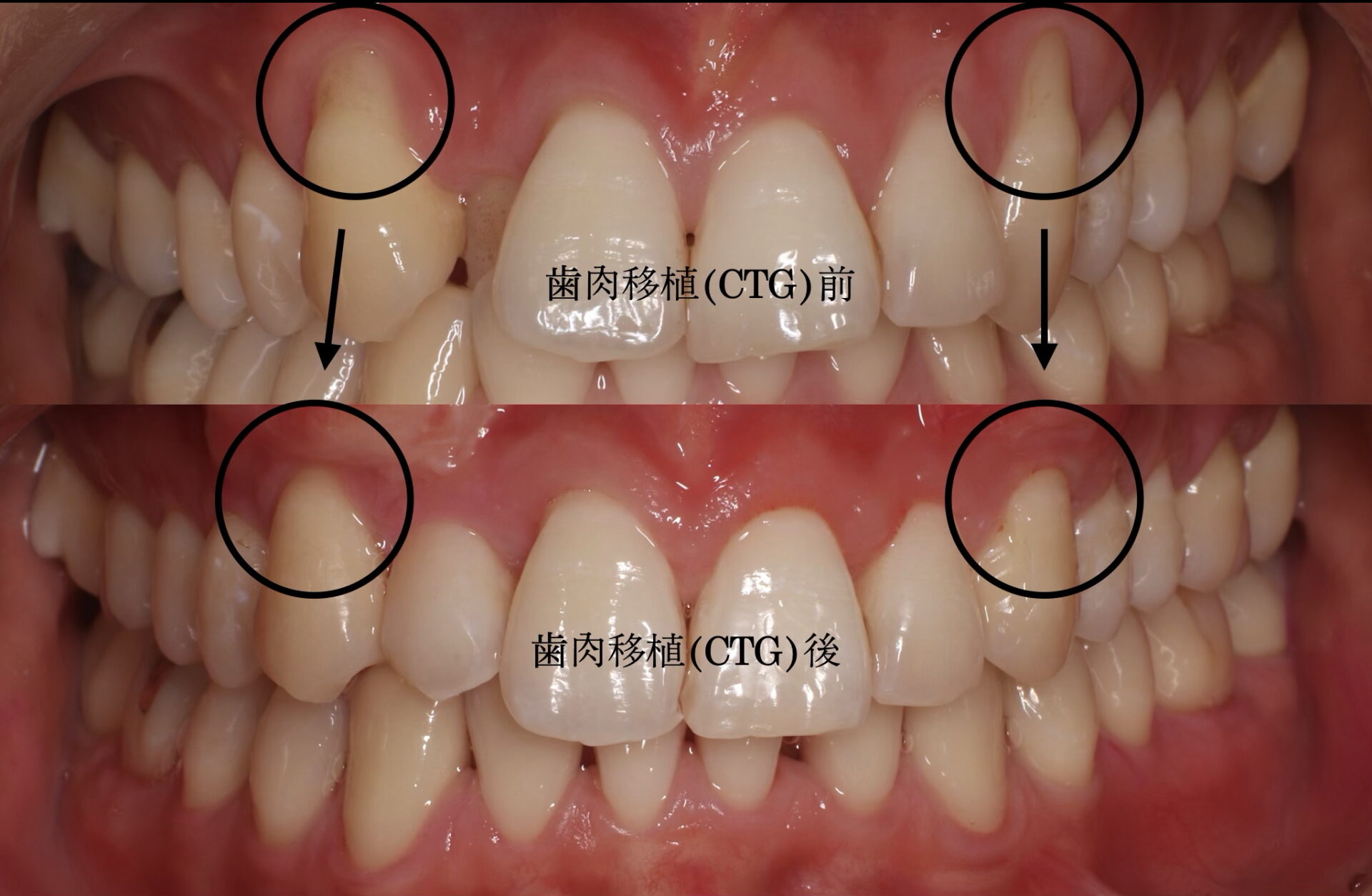 矯正治療に関連した歯肉退縮に対する結合組織移植術