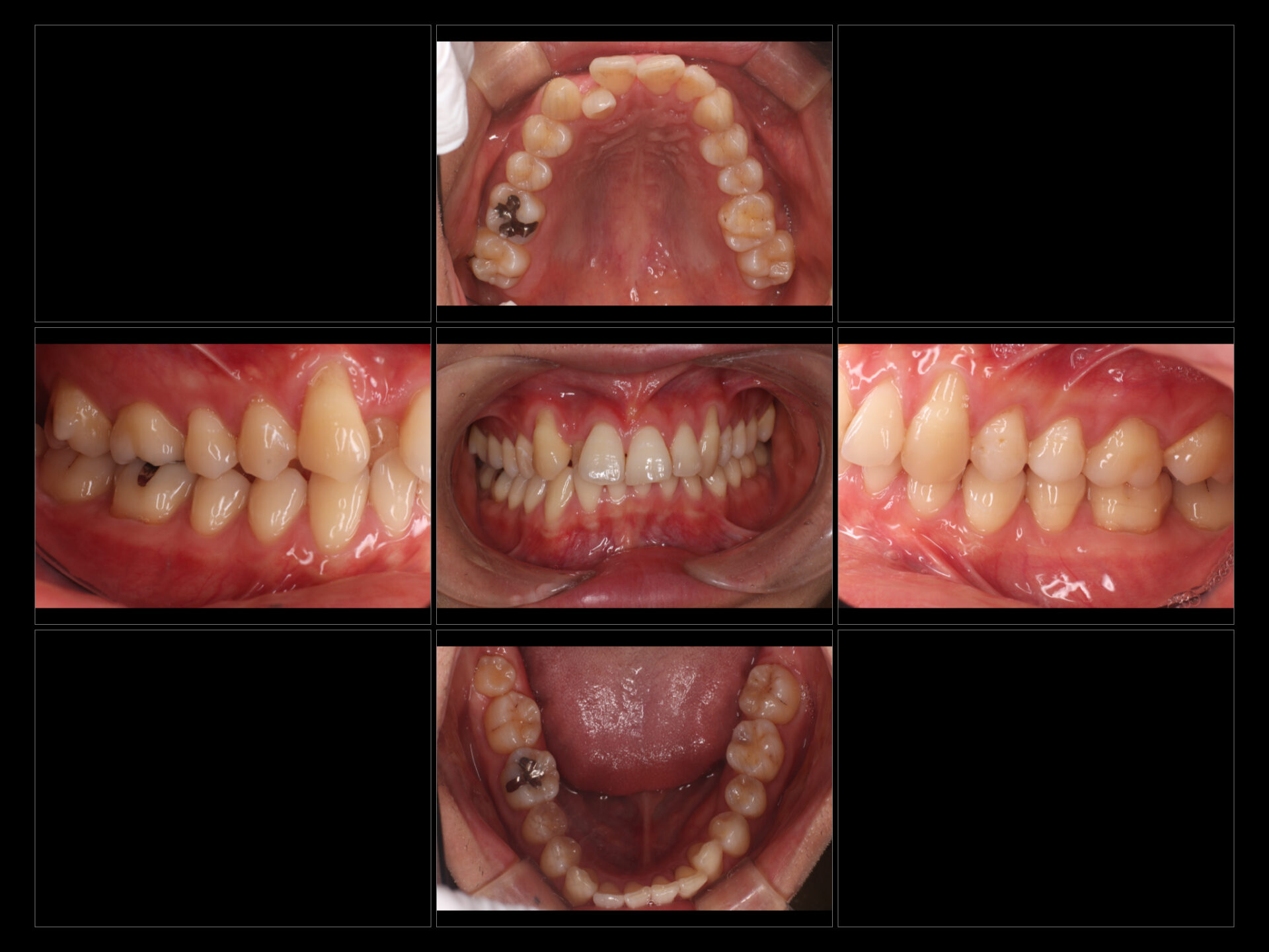 アライナー矯正前