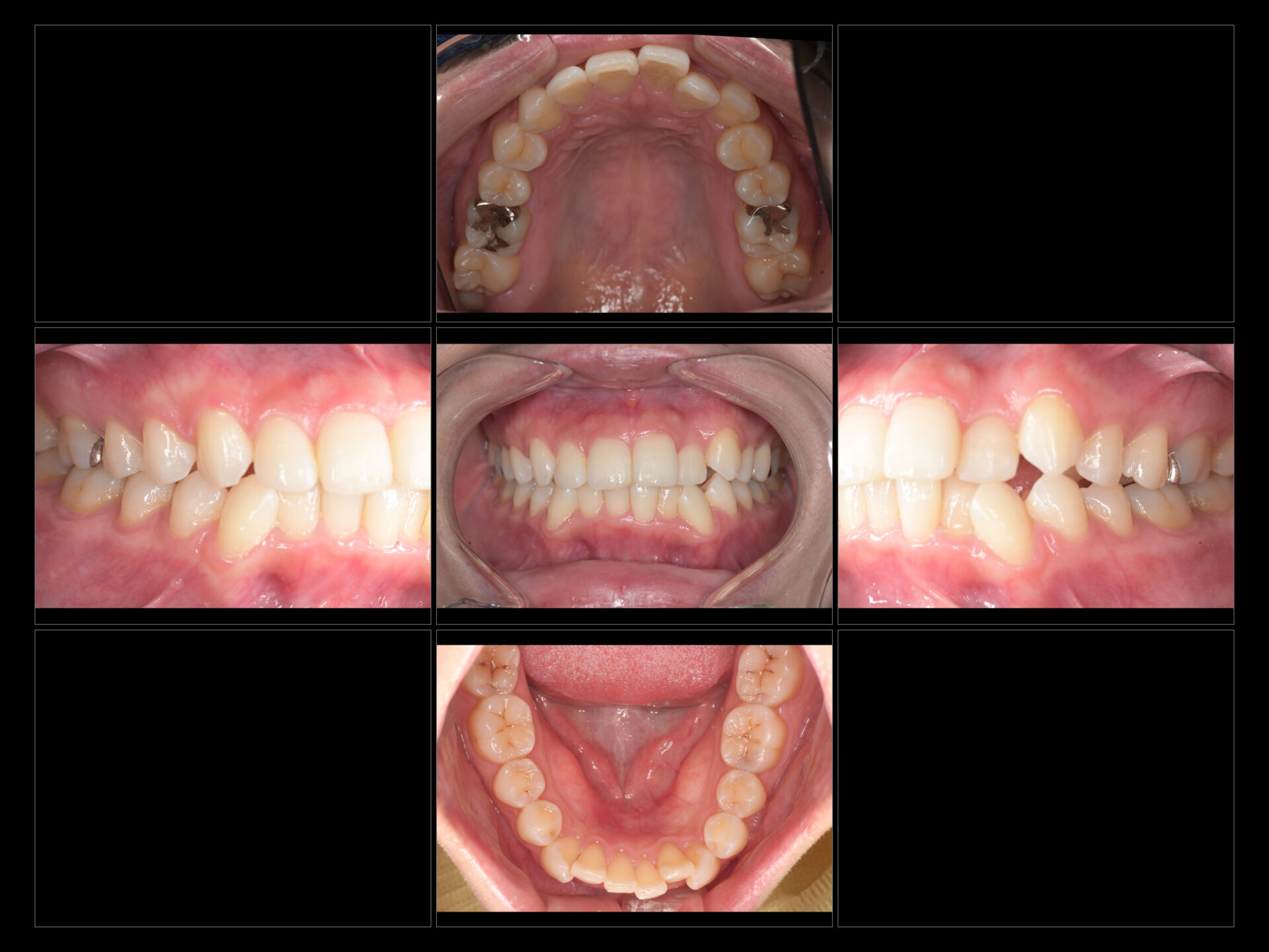 マウスピース矯正の口腔内写真、治療前